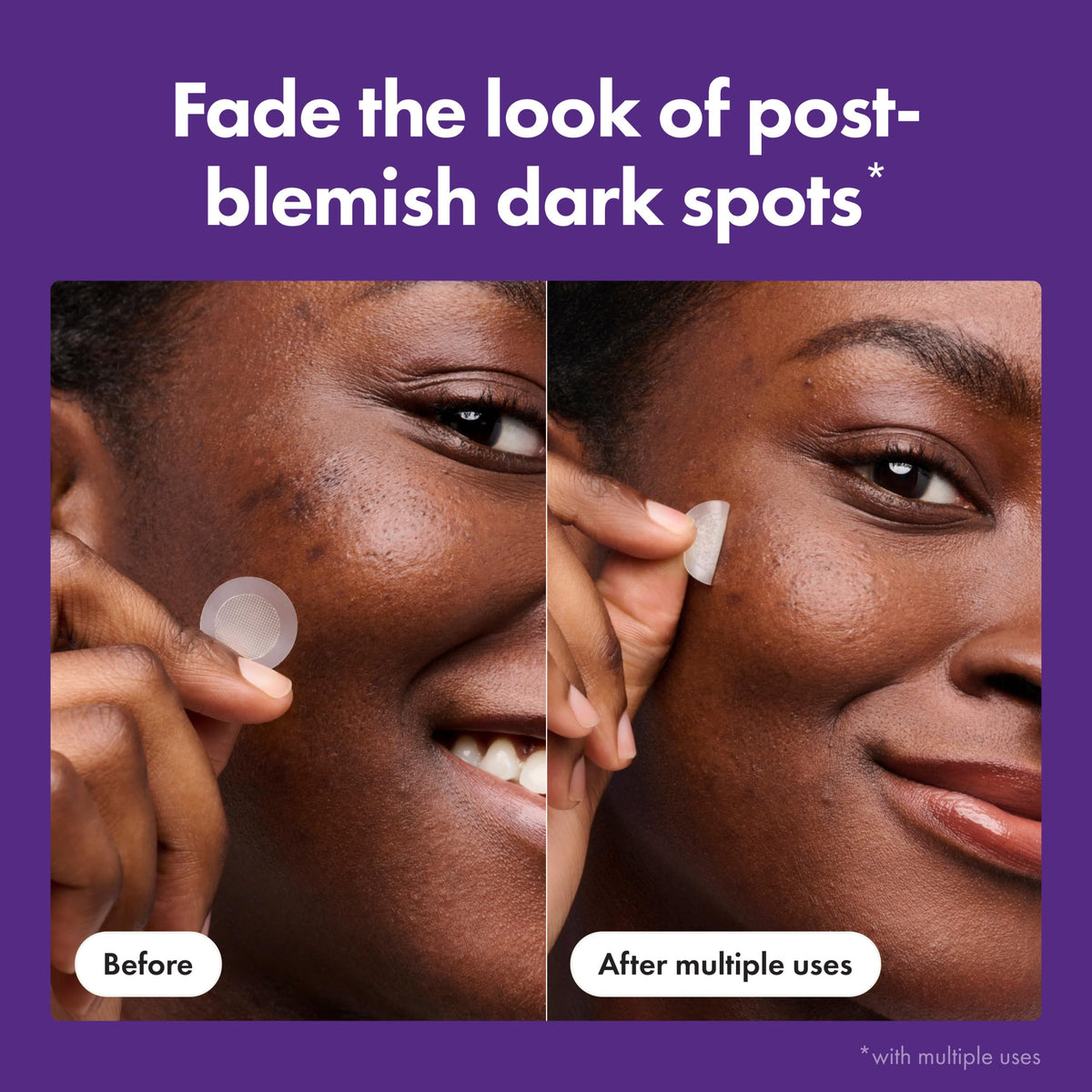Mighty Patch Hero Cosmetics for Dark Spots Post-Blemish Patch, 8 Ct Mighty Patch