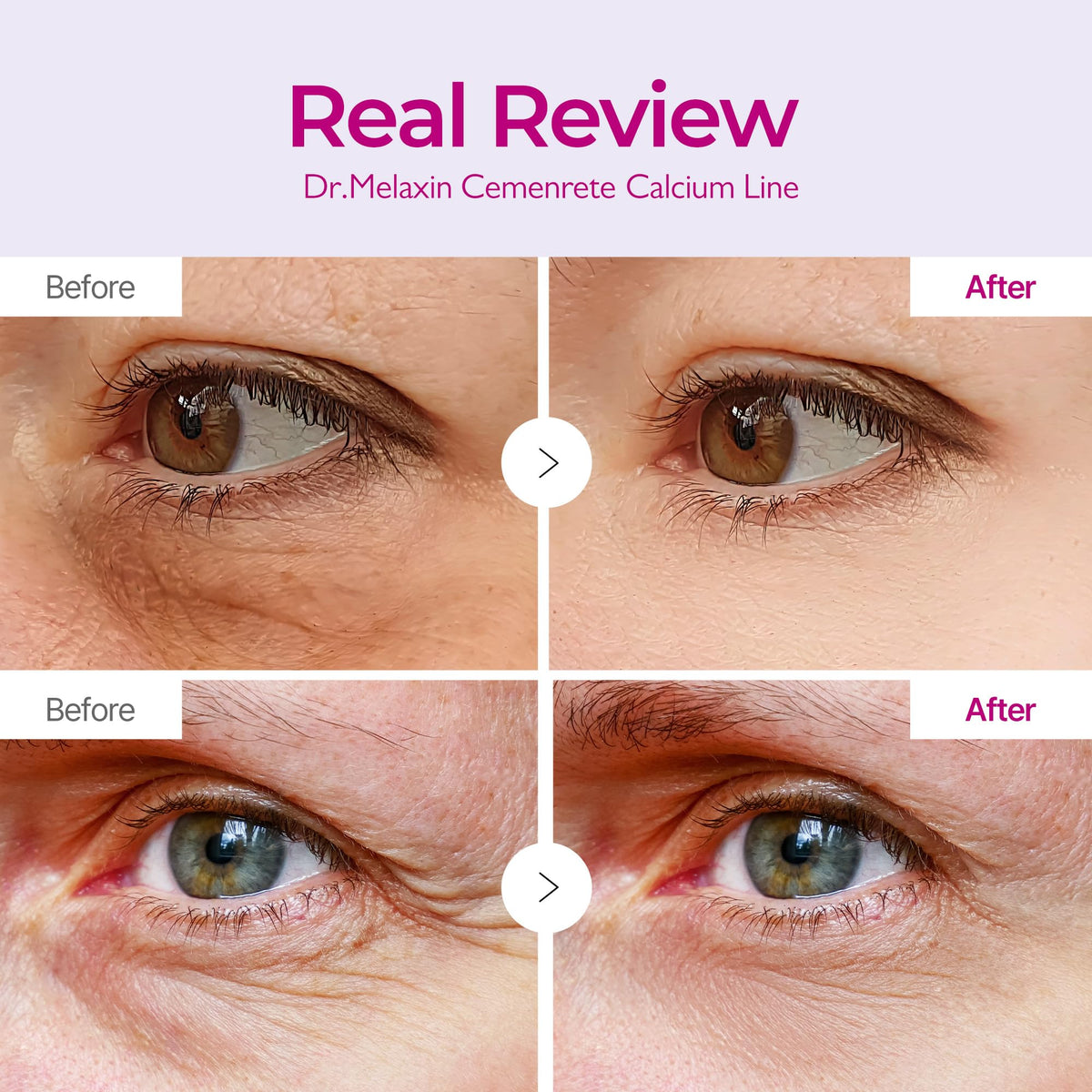 Dr.Melaxin Calcium Volume Under Eye Patches for Puffy Eyes & Dark Circles, Hydrogel Eye Mask for Wrinkles, Fine Lines & Sagging Skin, Firming Collagen Eye Patch, Korean Skin Care (60 Count) Dr.Melaxin