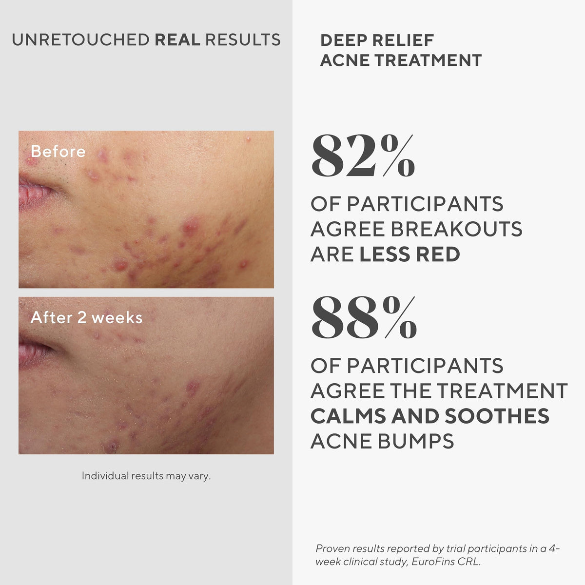 Murad Deep Relief Acne Spot Treatment - 2% Salicylic Acid - 1 Fl Oz Murad