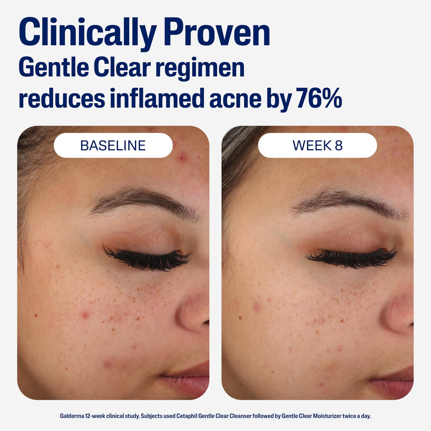 Cetaphil Face Moisturizer, Gentle Clear Mattifying Acne Moisturizer With 0.5% Salicylic Acid Cetaphil