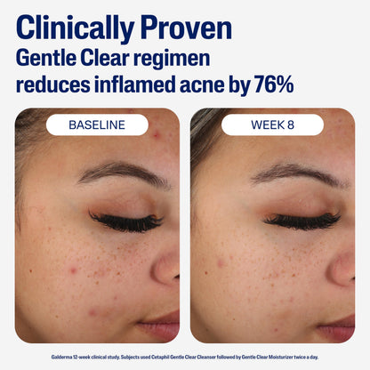 Cetaphil Face Moisturizer, Gentle Clear Mattifying Acne Moisturizer With 0.5% Salicylic Acid Cetaphil