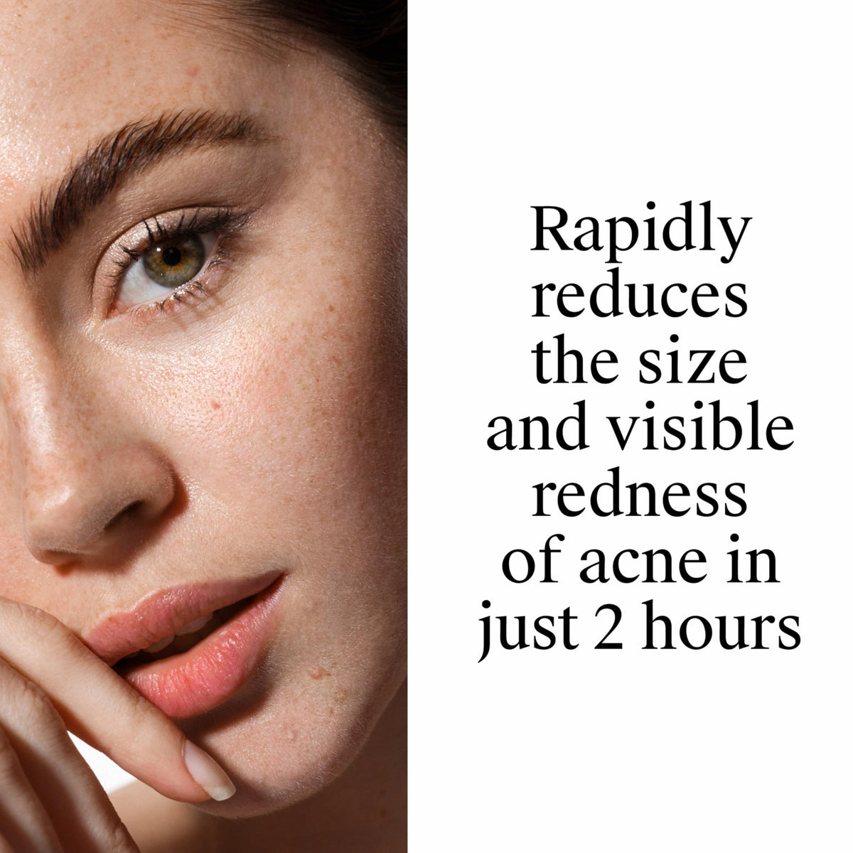 Neutrogena Rapid Clear Stubborn Acne Spot Treatment Gel, 1 oz Neutrogena
