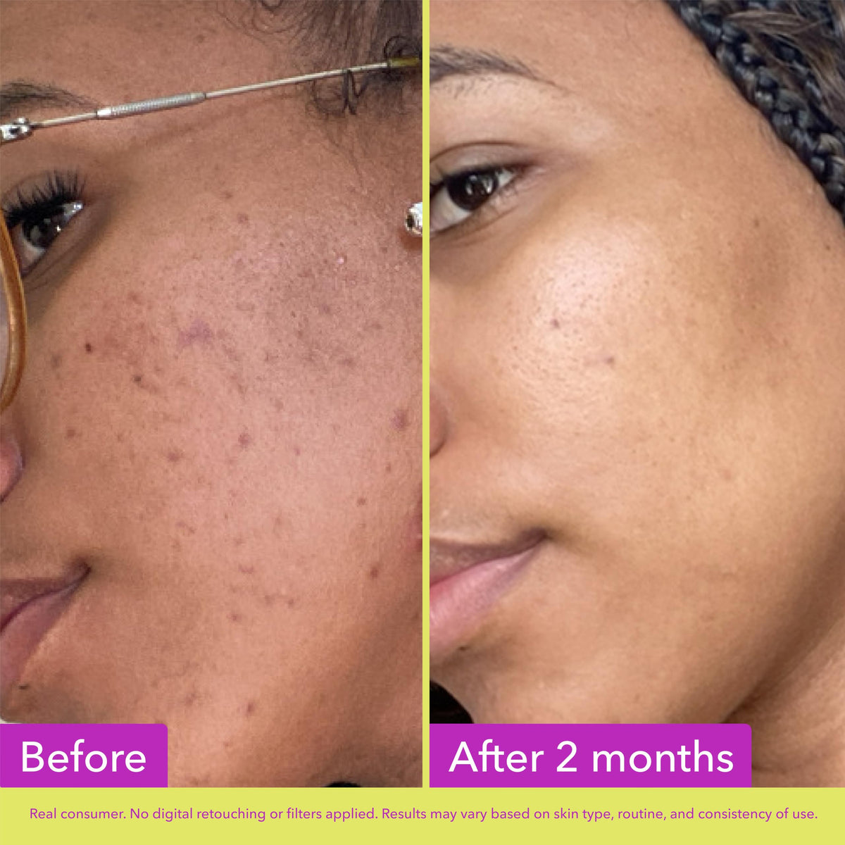 Good Molecules 10% Azelaic Acid Treatment for Face – Blurs Facial Redness & Evens Skin Tone – Brightens the Look of Dark Spots & Refines Texture – Vegan & Fragrance-Free Skincare (30ml / 1.01 fl oz.) Good Molecules