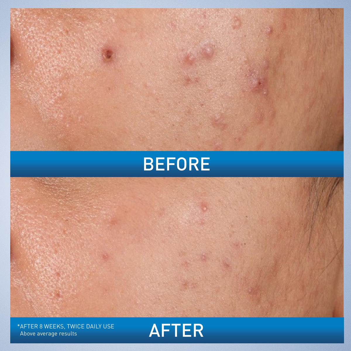 CeraVe Acne Control Gel, Salicylic & Glycolic Acid Face Treatment, 1.35oz CeraVe