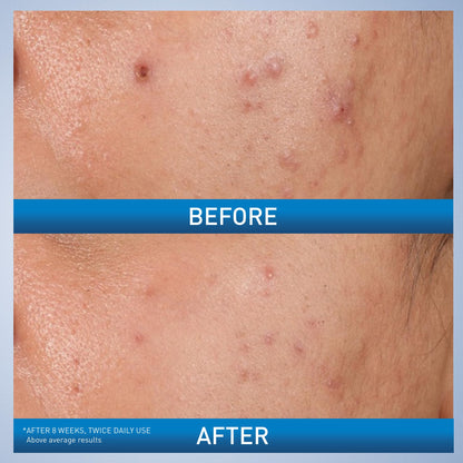 CeraVe Acne Control Gel, Salicylic & Glycolic Acid Face Treatment, 1.35oz CeraVe