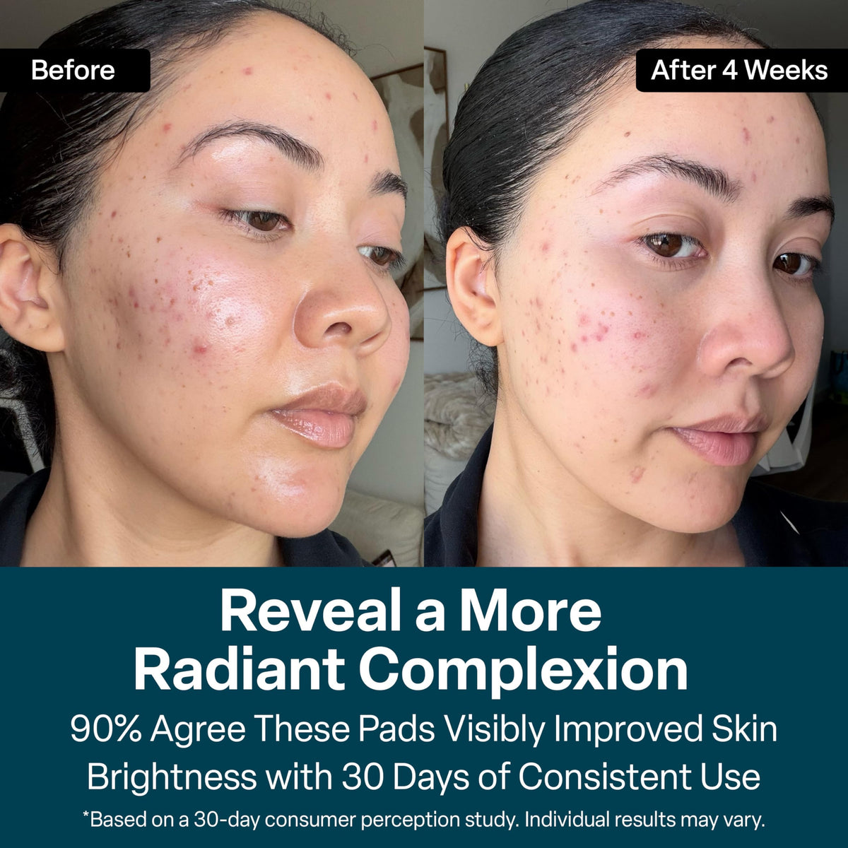 QRxLabs Glycolic Acid Pads - 20% Resurfacing Pads AHA for Face & Body - Exfoliates Skin Surface and Reduces Appearance of Fine Lines and Wrinkles - Acne Treatment Clearing - Daily Pads - 50ct QRxLabs