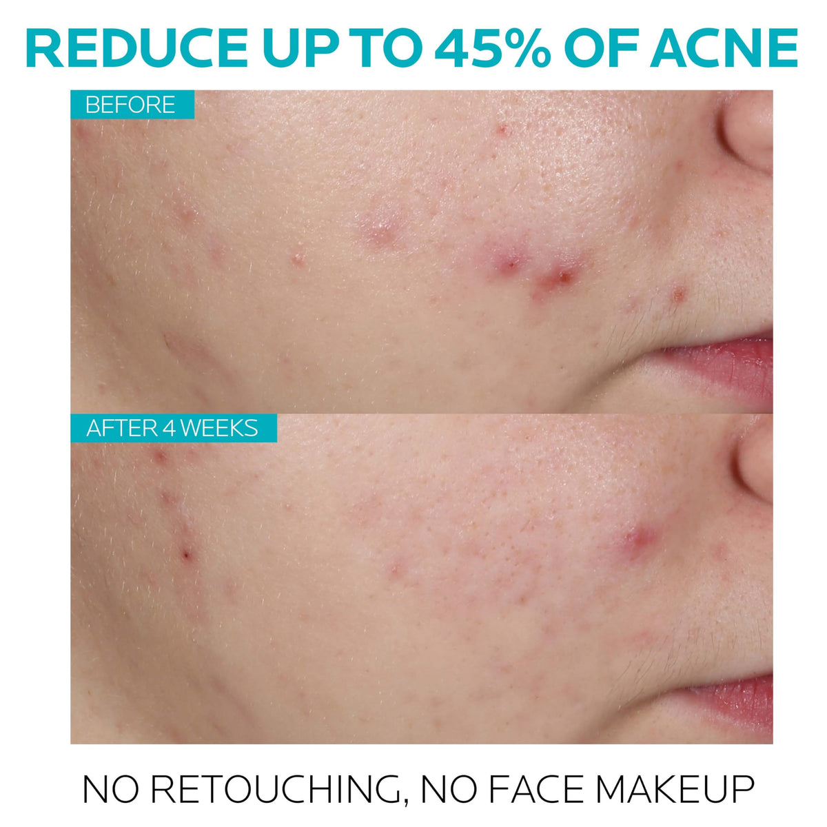 La Roche-Posay Effaclar Salicylic Acid Acne Treatment Pore Minimizer 1oz La Roche-Posay
