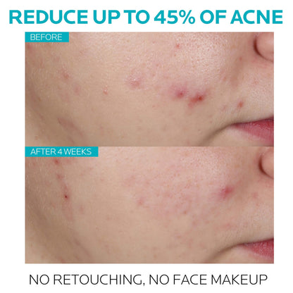 La Roche-Posay Effaclar Salicylic Acid Acne Treatment Pore Minimizer 1oz La Roche-Posay
