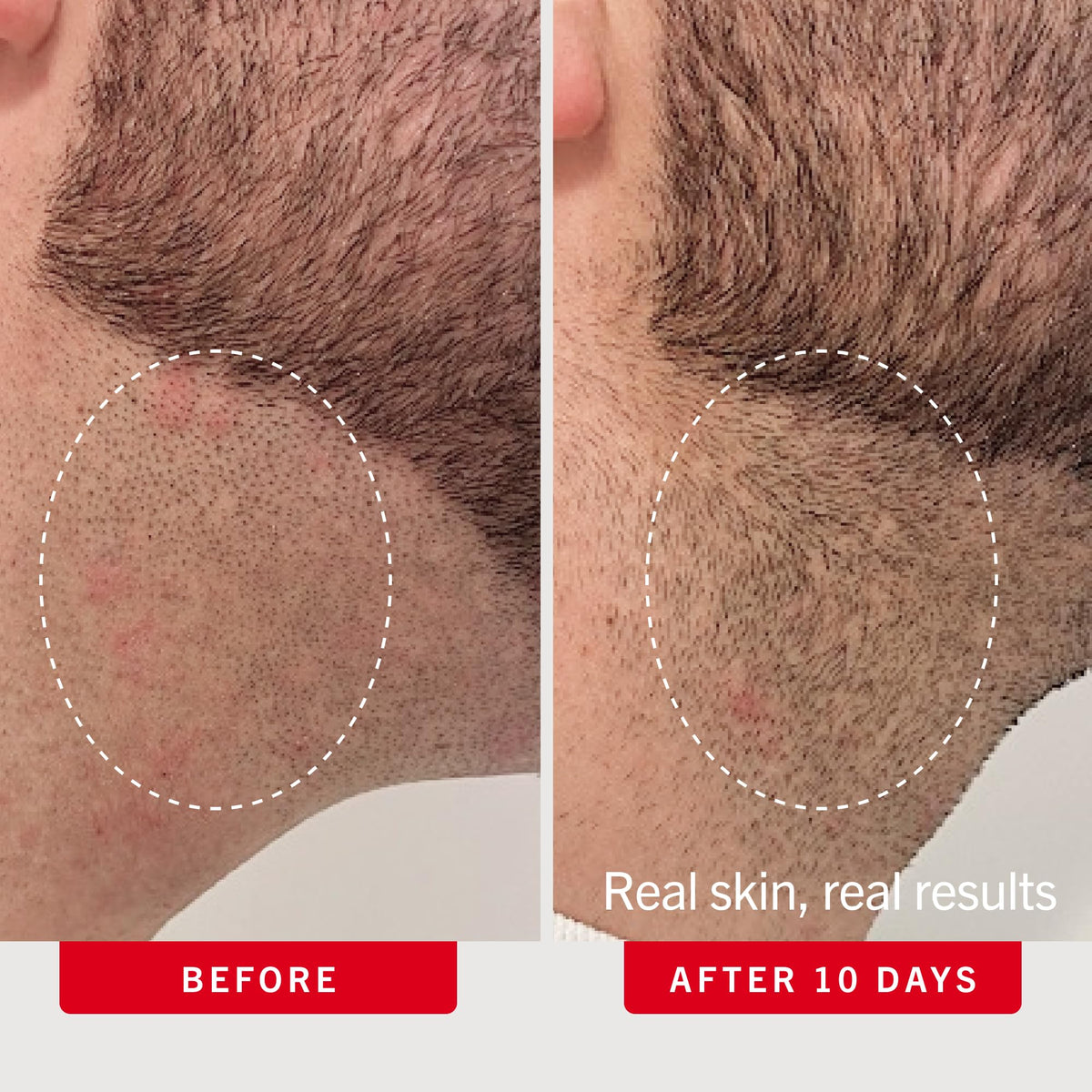 First Aid Beauty Ingrown Hair Pads with BHA and AHA, 28 ct First Aid Beauty