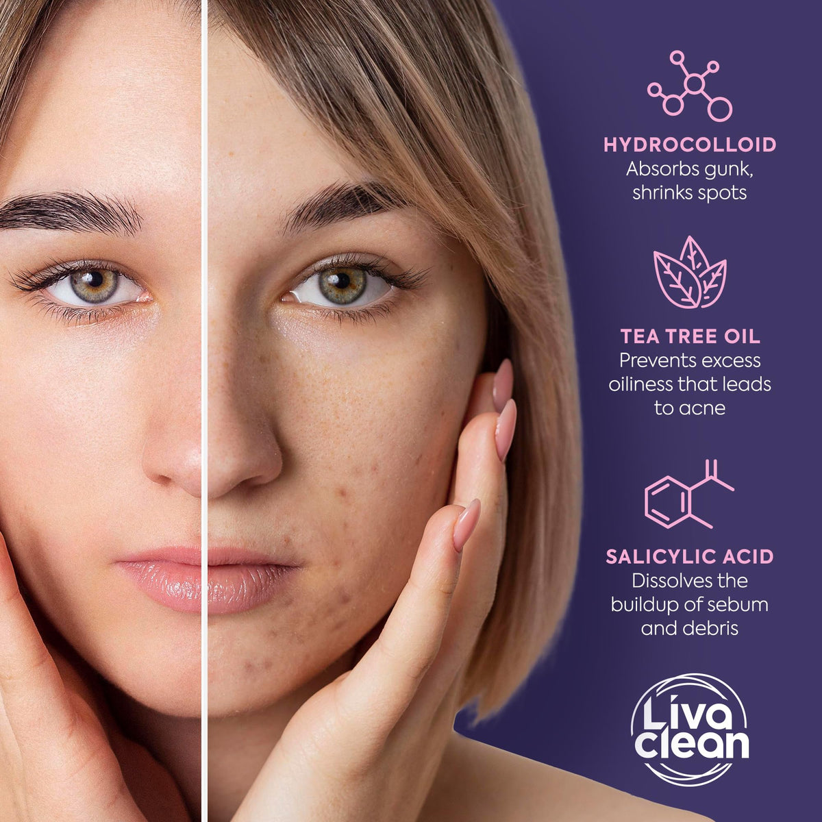 Livaclean 240CT Star Pimple Patches for Face w/ Hydrocolloid, Tea Tree oil & Salicylic Acid - Zit Stickers, Hydrocolloid Acne Patches for Face - Cute Pimple Patch, Acne Stickers LivaClean