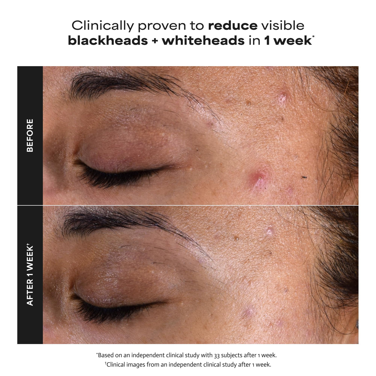 Paula's Choice SKIN PERFECTING 2% BHA Liquid Exfoliant, 4 Fl Oz Paula's Choice