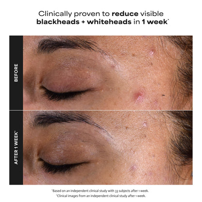 Paula's Choice SKIN PERFECTING 2% BHA Liquid Exfoliant, 4 Fl Oz Paula's Choice