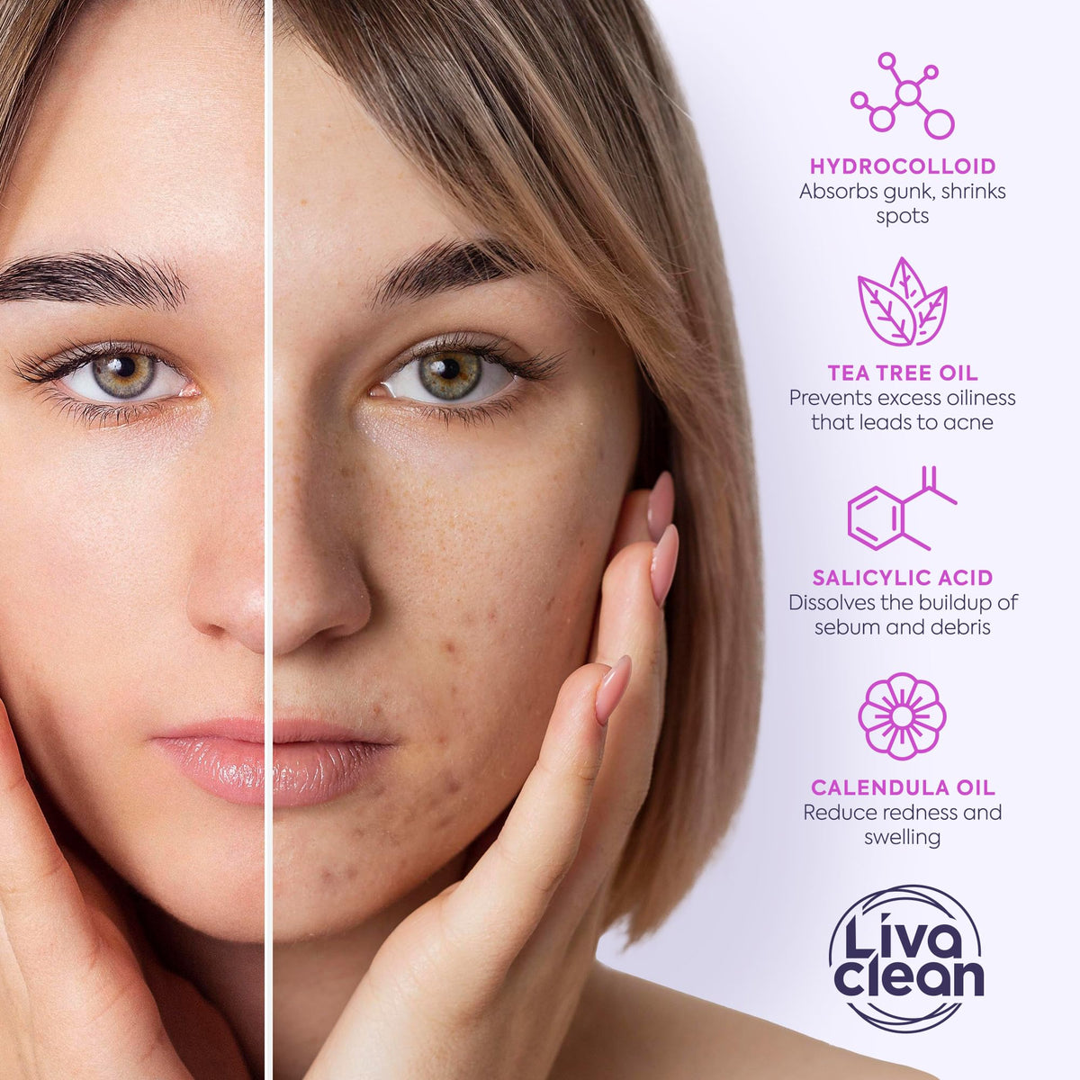 LivaClean 330 CT Pimple Patches for Face w/Salicylic Acid, Tea Tree Oil & Calendula Oil - Four Sizes - Pimple Patch, Hydrocolloid Patch, Acne Patches for Face LivaClean