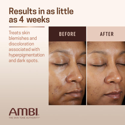 Ambi Even & Clear Advanced Fade Cream, Hydroquinone-free, Hyperpigmentation Treatment, Stubborn Dark Spot Corrector, Results In As Little As 2-3 Weeks, Niacinamide, Licorice Root Extract, PHA, 1 Fl Oz Ambi