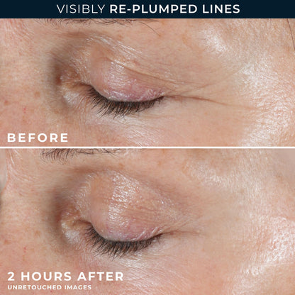 RoC Retinol Correxion Deep Wrinkle Non-Invasive Targeted Patches with Hyaluronic Acid + Firming Peptides for Forehead, 11 Lines RoC