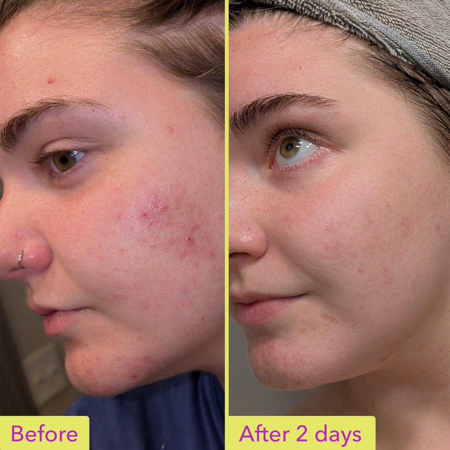 Good Molecules 10% Azelaic Acid Treatment for Face – Soothing Formula for Facial Redness Good Molecules