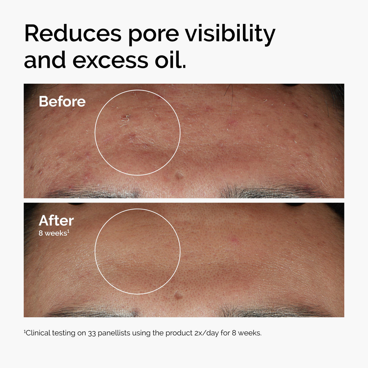 The Ordinary Niacinamide 10% + Zinc 1%, Smoothing Serum for Blemish-Prone Skin, 1 Fl Oz The Ordinary