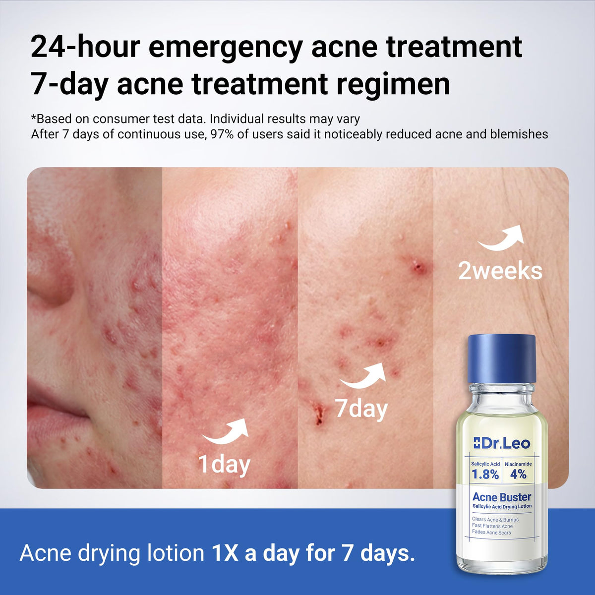 Dr.Leo 1.8% Salicylic Acid Acne Spot Treatment Drying Lotion, 0.34oz Dr.Leo