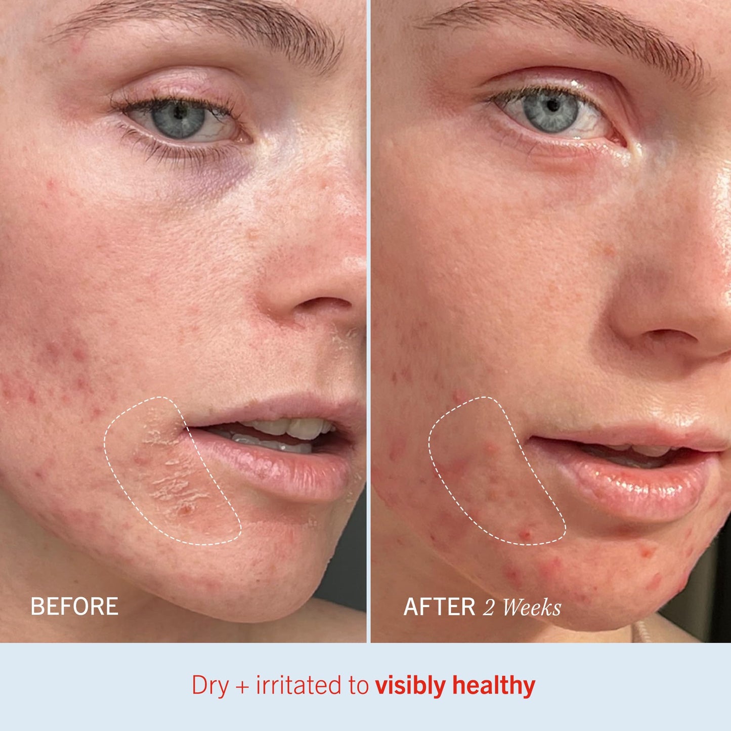 First Aid Beauty - Ultra Repair Cream, Intense Hydration Whipped Colloidal Oatmeal, Clinically Proven to Strengthen Skin Barrier in 7 Days First Aid Beauty