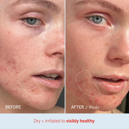 First Aid Beauty - Ultra Repair Cream, Intense Hydration Whipped Colloidal Oatmeal, Clinically Proven to Strengthen Skin Barrier in 7 Days First Aid Beauty