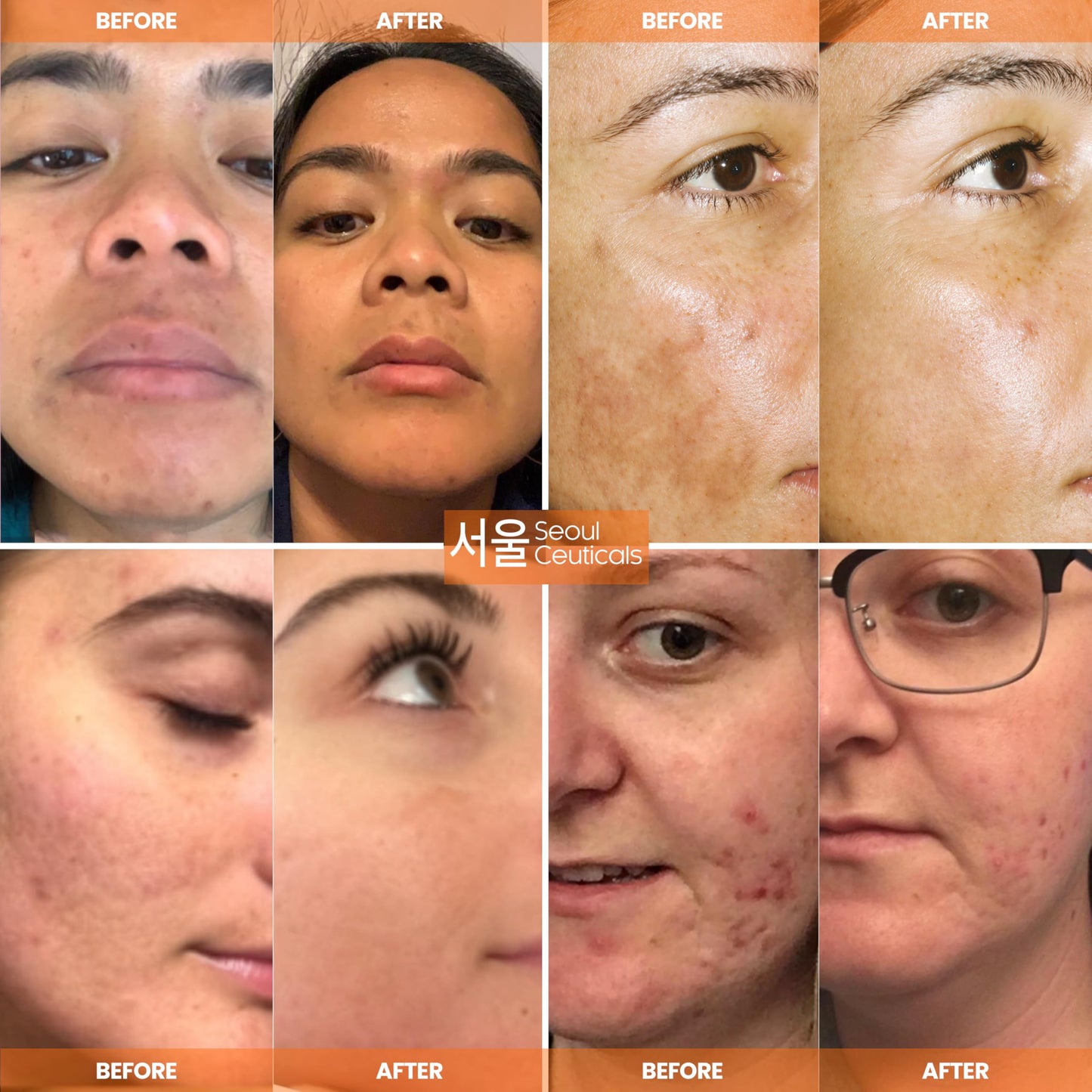 SeoulCeuticals Korean Skin Care 20% Vitamin C Hyaluronic Acid Serum + CE Ferulic Acid SeoulCeuticals