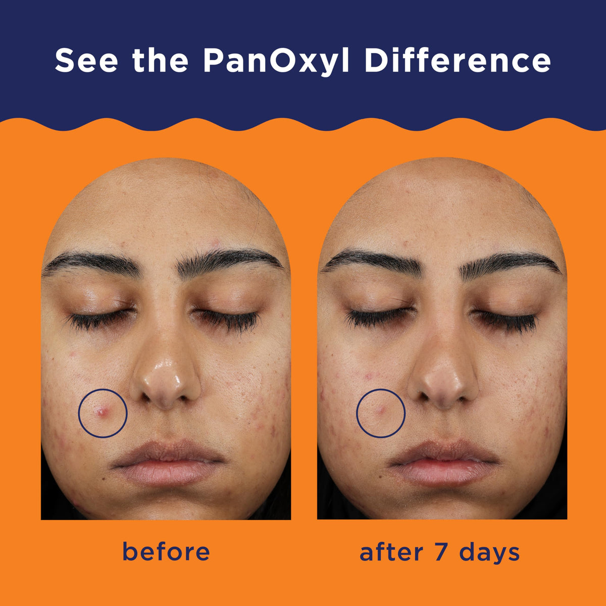 PanOxyl Acne Clearing Spot Treatment, 10% Benzoyl Peroxide, For Face, 1 oz PanOxyl