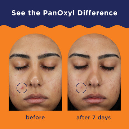 PanOxyl Acne Clearing Spot Treatment, 10% Benzoyl Peroxide, For Face, 1 oz PanOxyl