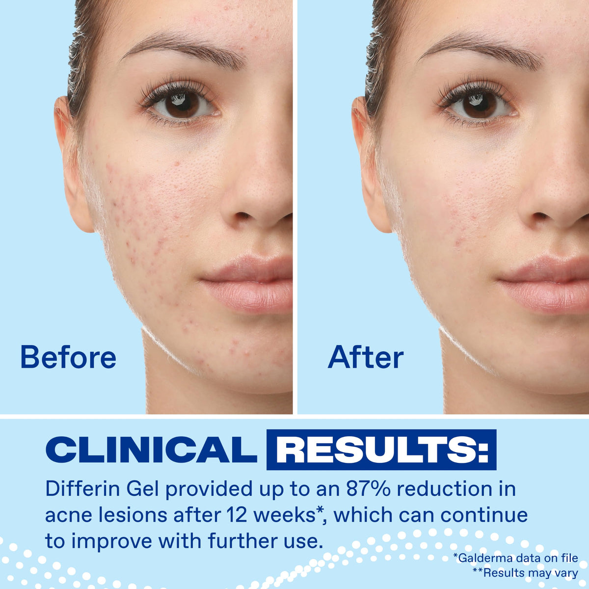 Differin Acne Retinoid Treatment Gel, 0.1% Adapalene, 45g Pump Differin