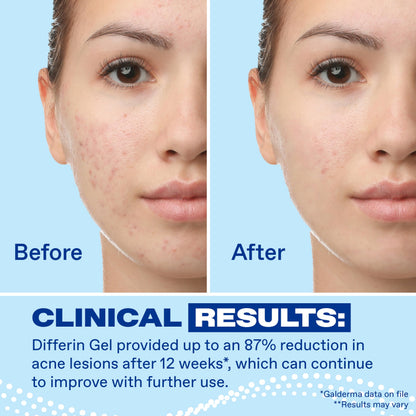 Differin Acne Retinoid Treatment Gel, 0.1% Adapalene, 45g Pump Differin