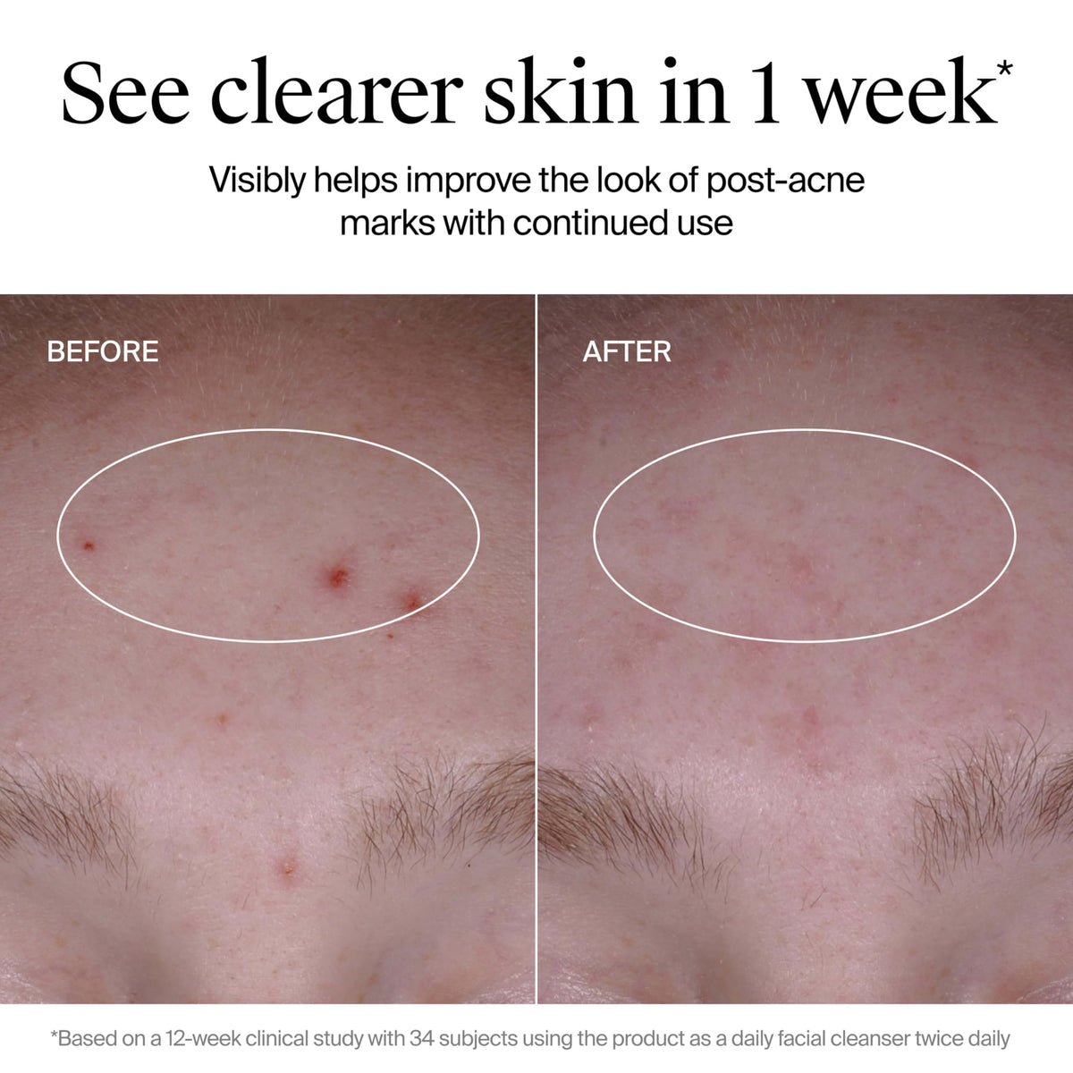 Neutrogena Evenly Clear Acne Cleanser, 9.1 fl. oz Neutrogena