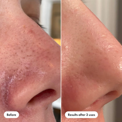Hero Cosmetics Pore Release Blackhead Clearing Solution, Exfoliating 2% Salicylic Acid Toner Featuring AHA, BHA, and PHA HERO COSMETICS