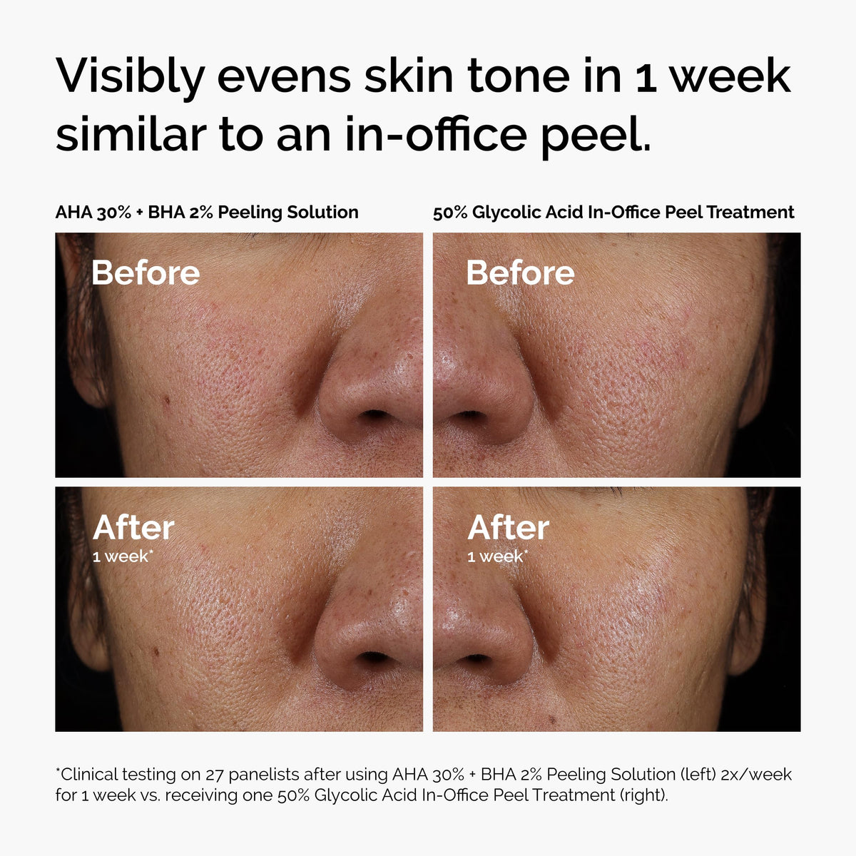 The Ordinary AHA 30% + BHA 2% Peeling Solution, Advanced Exfoliating Peel for Brighter Skin, 1 Fl Oz The Ordinary