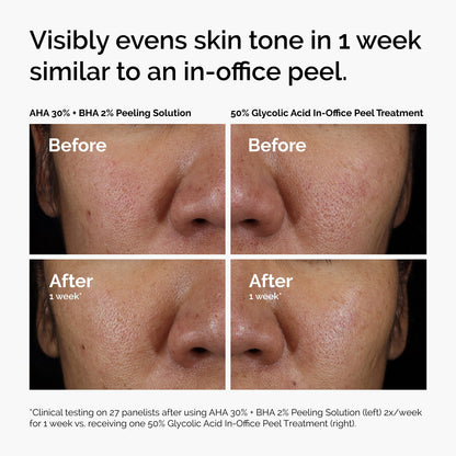 The Ordinary AHA 30% + BHA 2% Peeling Solution, Advanced Exfoliating Peel for Brighter Skin, 1 Fl Oz The Ordinary