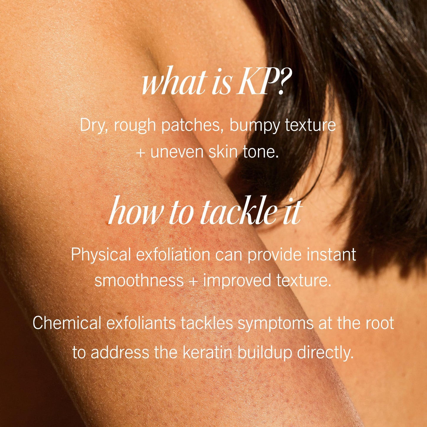 First Aid Beauty - KP Bump Eraser Body Scrub with 10% AHA, Keratosis Pilaris Exfoliator with Glycolic and Lactic acids, Helps Reduce Chicken Skin Bumps First Aid Beauty