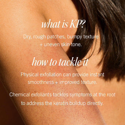 First Aid Beauty - KP Bump Eraser Body Scrub with 10% AHA, Keratosis Pilaris Exfoliator with Glycolic and Lactic acids, Helps Reduce Chicken Skin Bumps First Aid Beauty