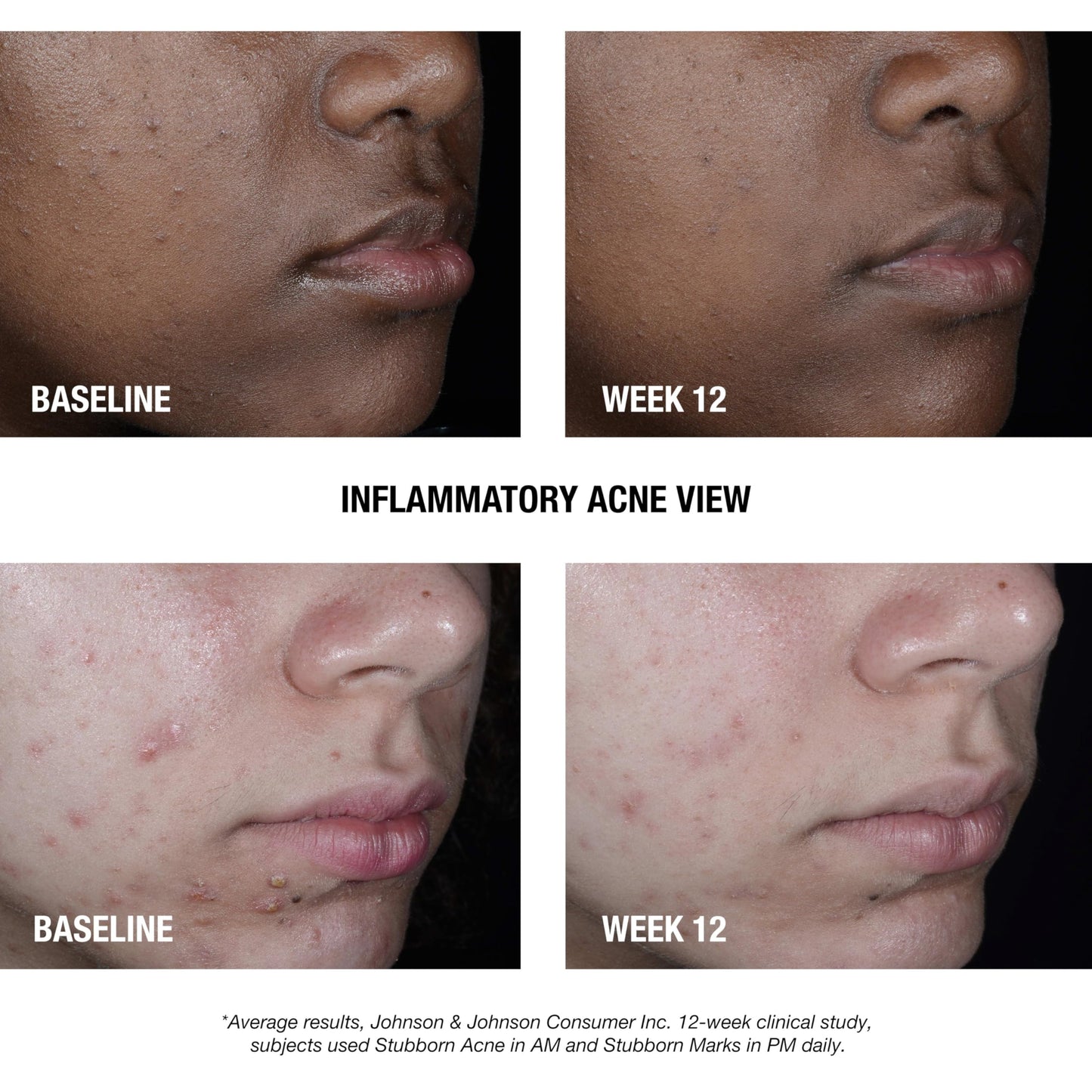 Neutrogena Stubborn Acne AM Face Treatment with 2.5% Micronized Benzoyl Peroxide Acne Medication, Oil-Free Daily Facial Treatment Reduces Size Neutrogena